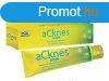 ESI aCknes gl - Akns brre, mint pattans, mitesszer, fe
